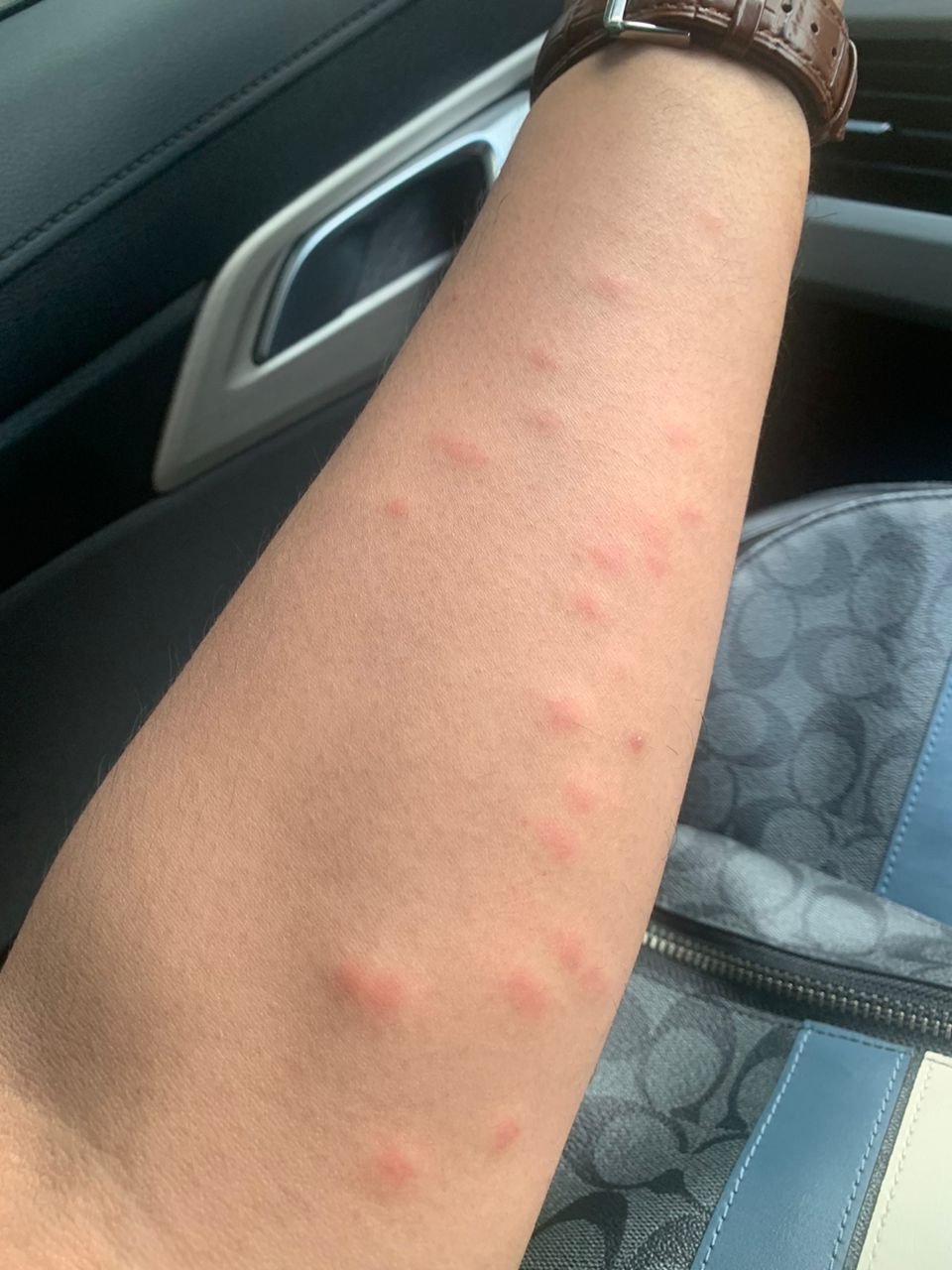 Tangan Hariz menjadi kemerah-merahan akibat digigit nyamuk. - Gambar PR