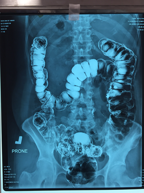 Penyakit divertikula dilihat melalui X-ray abdomen