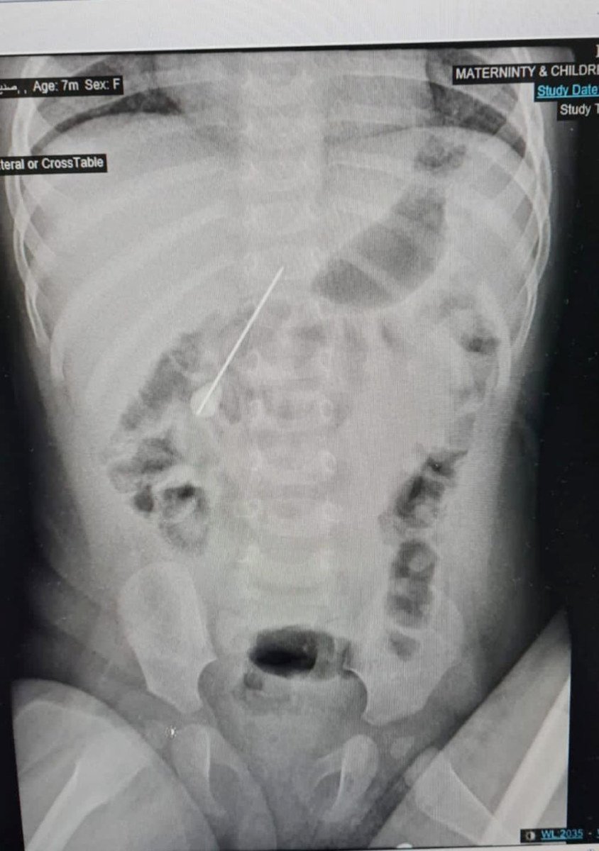 X-ray menunjukkan jarum di dalam badan bayi perempuan berkenaan.